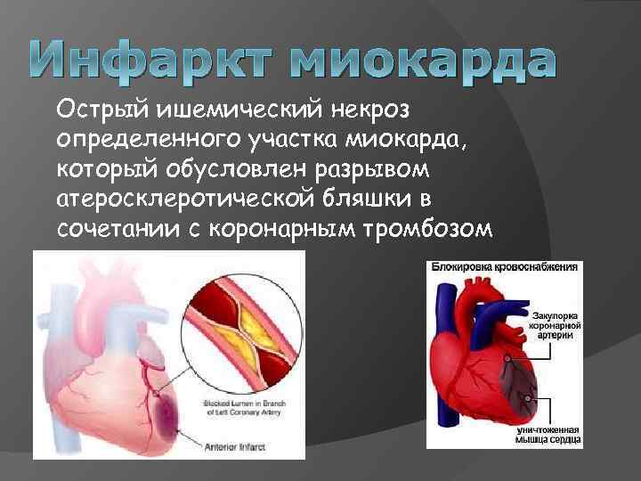 Инфаркт миокарда Острый ишемический некроз определенного участка миокарда, который обусловлен разрывом атеросклеротической бляшки в