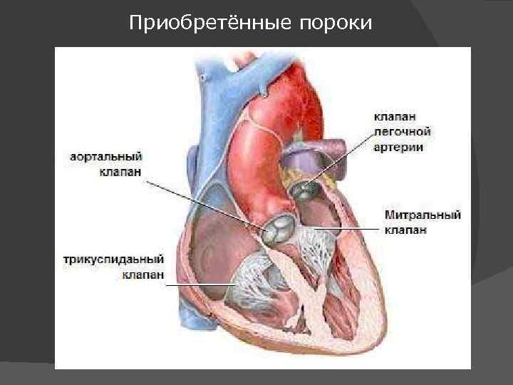 Приобретённые пороки 