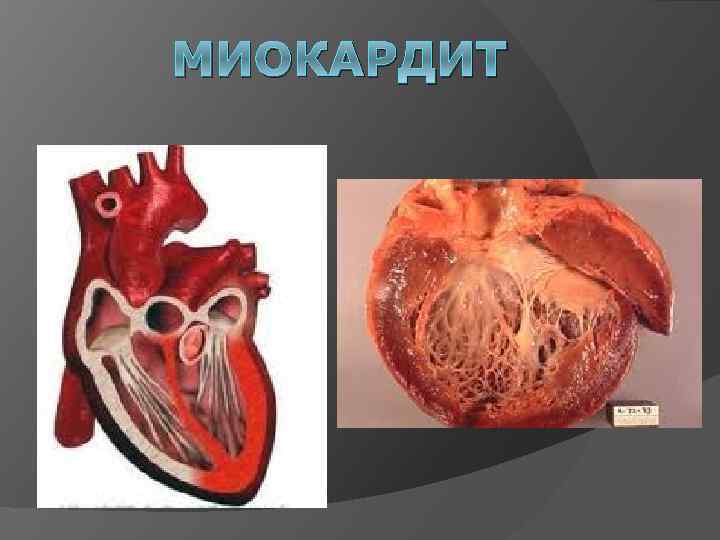 МИОКАРДИТ 