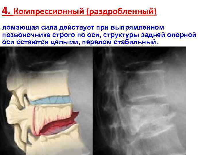 4. Компрессионный (раздробленный) ломающая сила действует при выпрямленном позвоночнике строго по оси, структуры задней