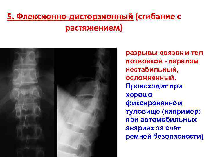 Перелом позвоночника презентация