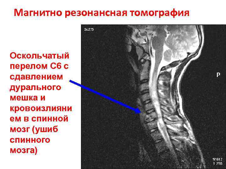 Магнитно резонансная томография Оскольчатый перелом С 6 с сдавлением дурального мешка и кровоизлияни ем