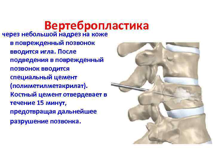 Вертебропластика через небольшой надрез на коже в поврежденный позвонок вводится игла. После подведения в