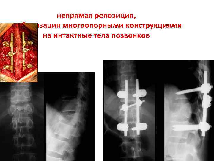 Повреждение позвоночника презентация