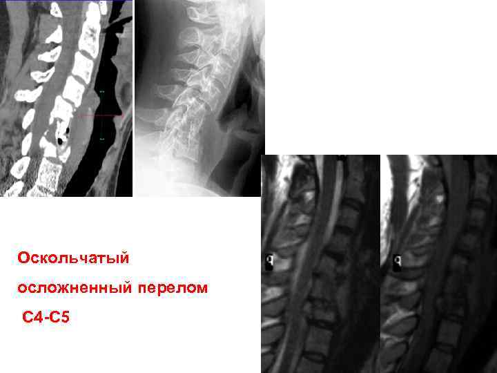 Перелом позвоночника презентация
