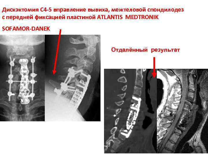 Дискэктомия шейного отдела