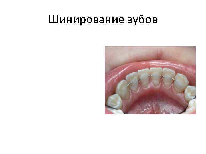 Шинирование зубов 