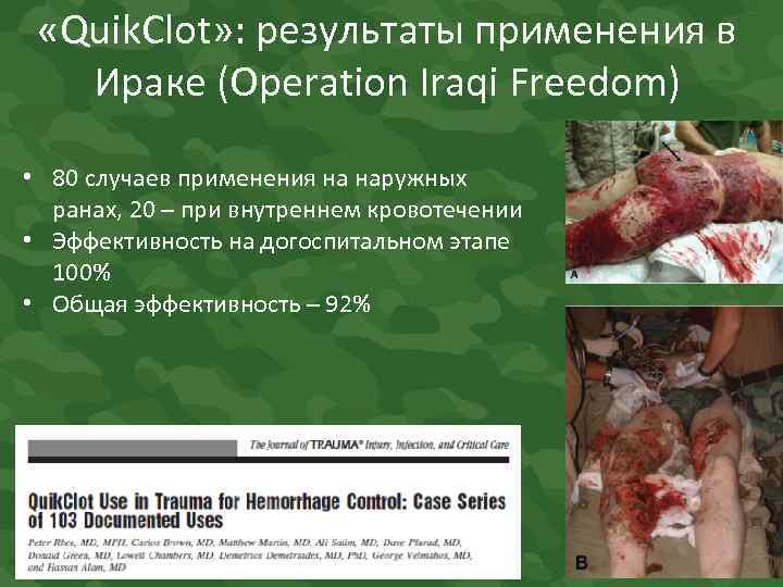  «Quik. Clot» : результаты применения в Ираке (Operation Iraqi Freedom) • 80 случаев