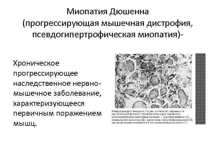 Миопатия Дюшенна (прогрессирующая мышечная дистрофия, псевдогипертрофическая миопатия)Хроническое прогрессирующее наследственное нервномышечное заболевание, характеризующееся первичным поражением