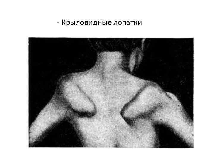 - Крыловидные лопатки 