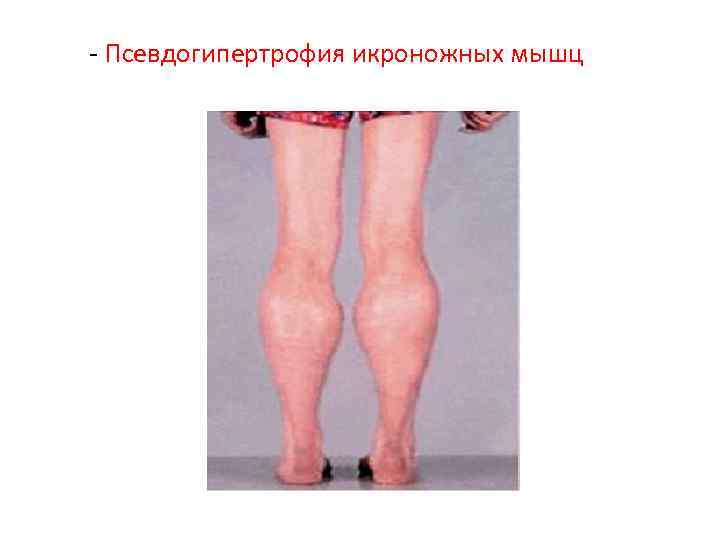 - Псевдогипертрофия икроножных мышц 