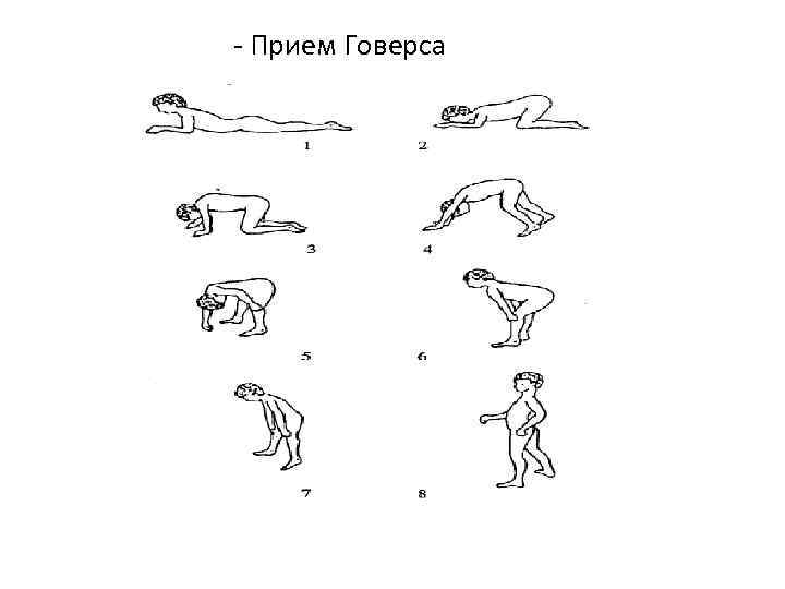 - Прием Говерса 