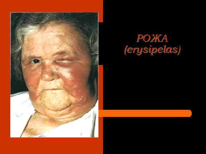 РОЖА (erysipelas) 