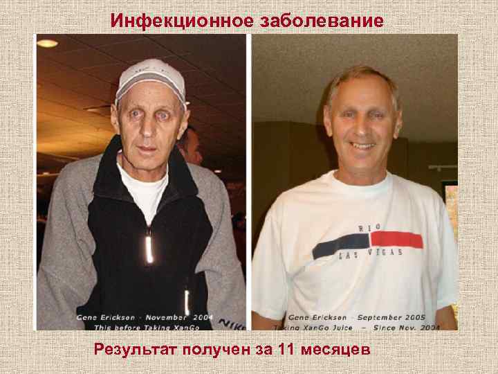 Инфекционное заболевание Результат получен за 11 месяцев 