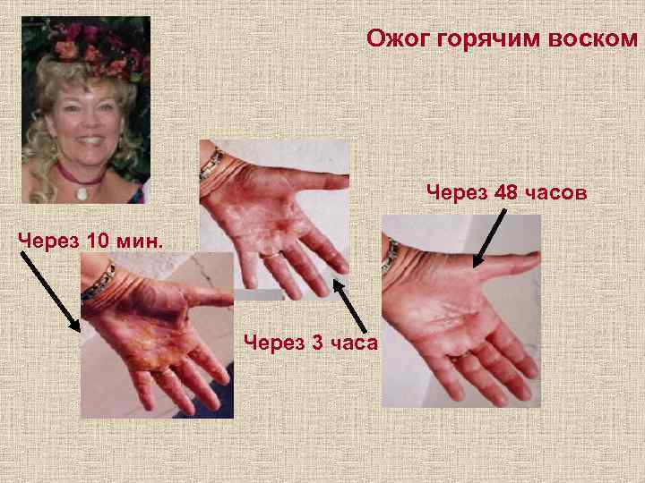 Ожог горячим воском Через 48 часов Через 10 мин. Через 3 часа 
