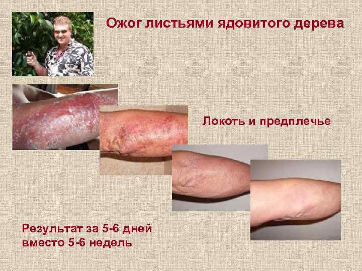 Ожог листьями ядовитого дерева Локоть и предплечье Результат за 5 -6 дней вместо 5