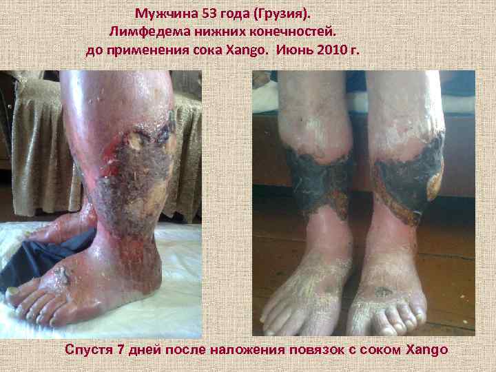 Мужчина 53 года (Грузия). Лимфедема нижних конечностей. до применения сока Xango. Июнь 2010 г.