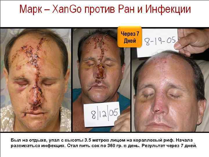 Был на отдыхе, упал с высоты 3. 5 метров лицом на коралловый риф. Начала