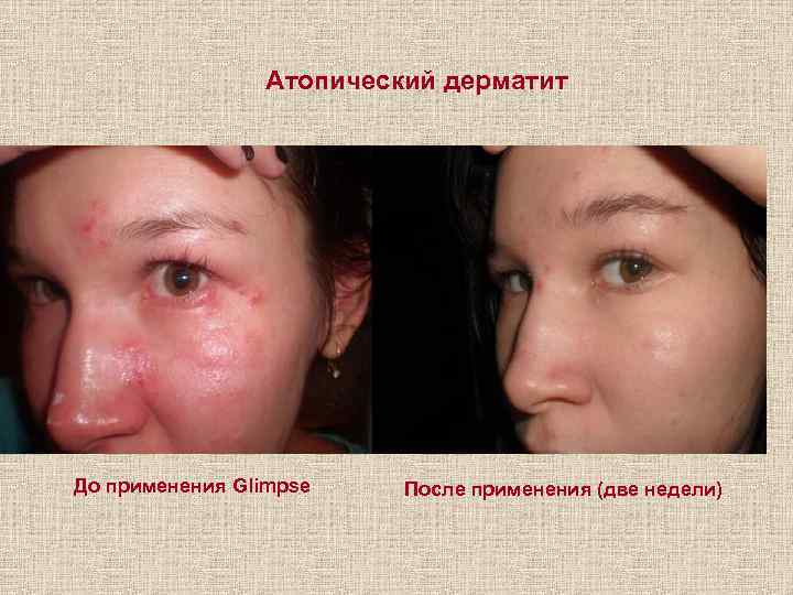 Атопический дерматит До применения Glimpse После применения (две недели) 