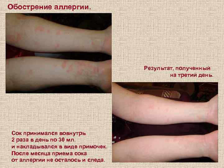 Обострение аллергии. Результат, полученный на третий день. Сок принимался вовнутрь 2 раза в день