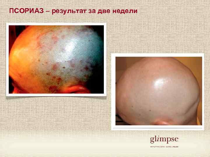 ПСОРИАЗ – результат за две недели 