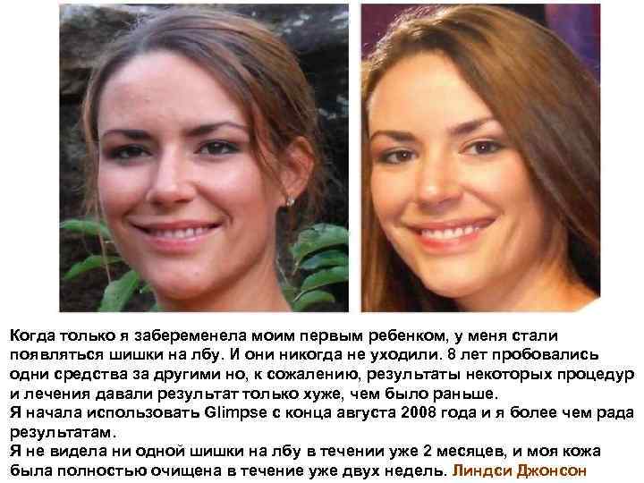 Когда только я забеременела моим первым ребенком, у меня стали появляться шишки на лбу.