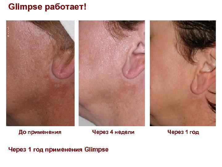 Glimpse работает! До применения Через 4 недели Через 1 год применения Glimpse Через 1