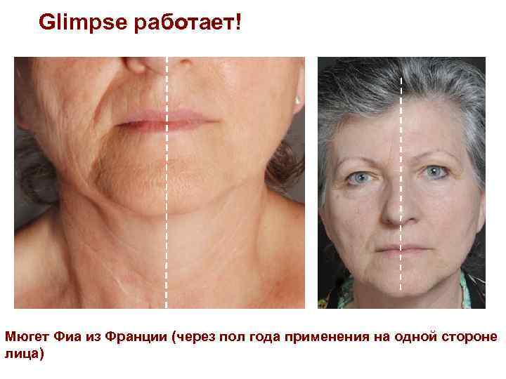 Glimpse работает! Мюгет Фиа из Франции (через пол года применения на одной стороне лица)