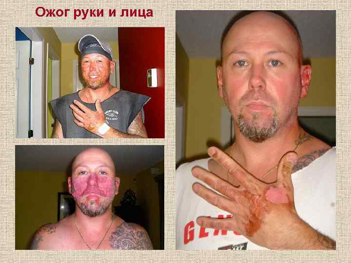 Ожог руки и лица 