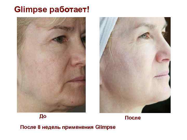 Glimpse работает! До После 8 недель применения Glimpse После 