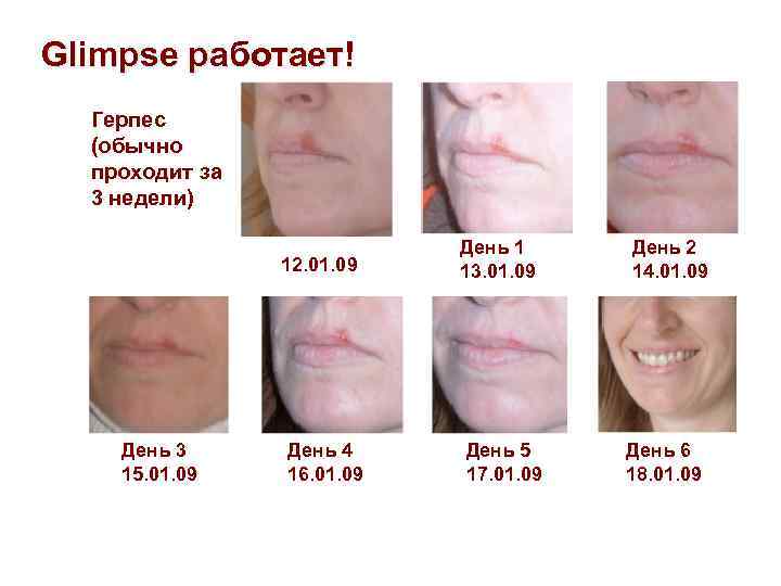 Glimpse работает! Герпес (обычно проходит за 3 недели) 12. 01. 09 День 3 15.