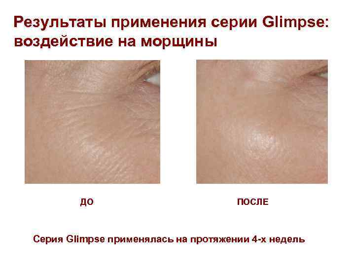 Результаты применения серии Glimpse: воздействие на морщины ДО ПОСЛЕ Серия Glimpse применялась на протяжении