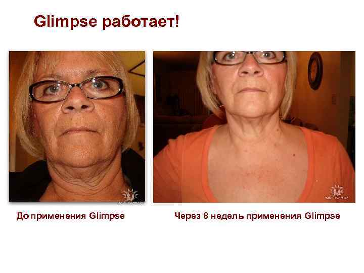 Glimpse работает! До применения Glimpse Через 8 недель применения Glimpse 
