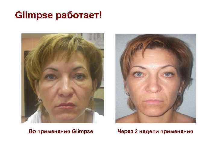 Glimpse работает! До применения Glimpse Через 2 недели применения 