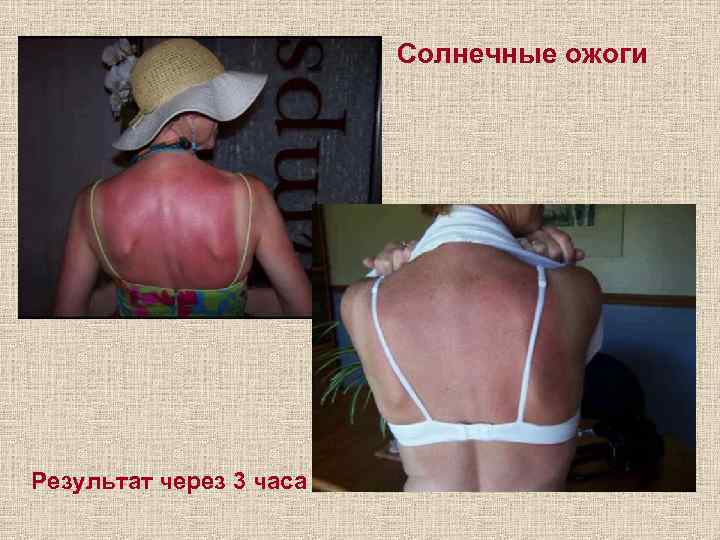 Солнечные ожоги Результат через 3 часа 