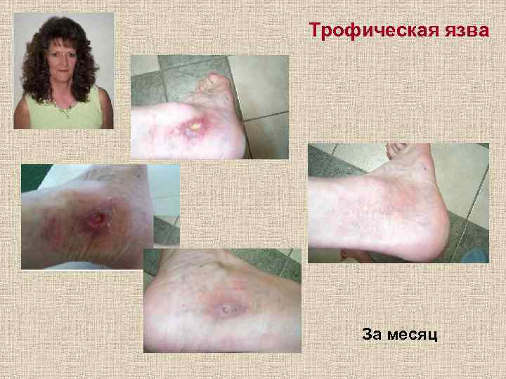 Трофическая язва За месяц 