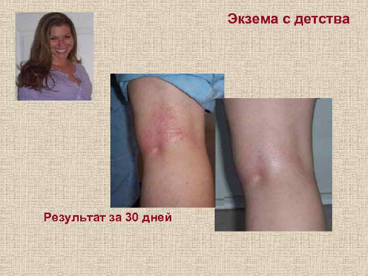 Экзема с детства Результат за 30 дней 