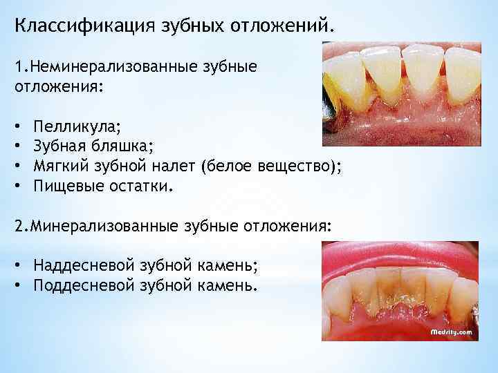 Классификация зубных отложений. 1. Неминерализованные зубные отложения: • • Пелликула; Зубная бляшка; Мягкий зубной