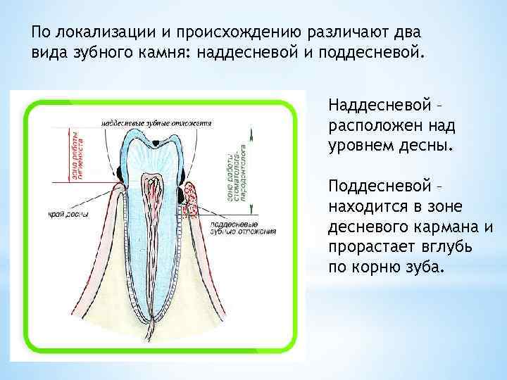 По локализации и происхождению различают два вида зубного камня: наддесневой и поддесневой. Наддесневой –