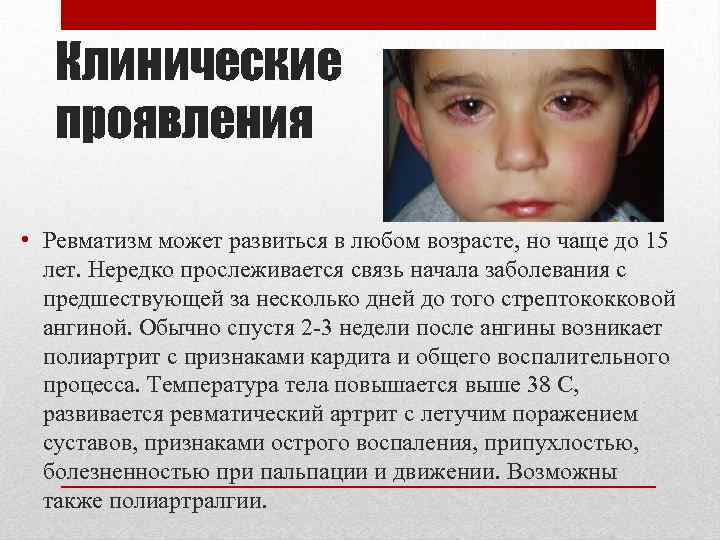 Клинические проявления • Ревматизм может развиться в любом возрасте, но чаще до 15 лет.