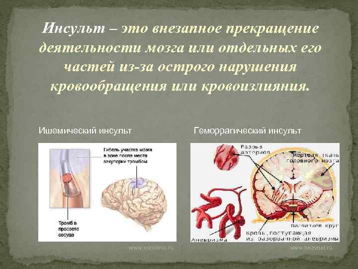 Инсульт – это внезапное прекращение деятельности мозга или отдельных его частей из-за острого нарушения