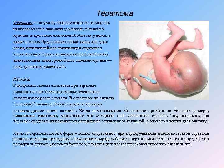 Тератома — опухоль, образующаяся из гоноцитов, наиболее часто в яичниках у женщин, в яичках