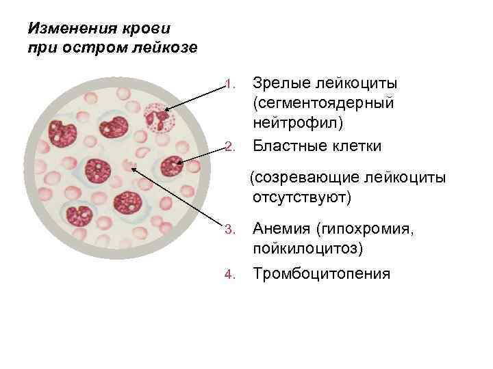 Изменения крови при остром лейкозе 1. 2. Зрелые лейкоциты (сегментоядерный нейтрофил) Бластные клетки (созревающие