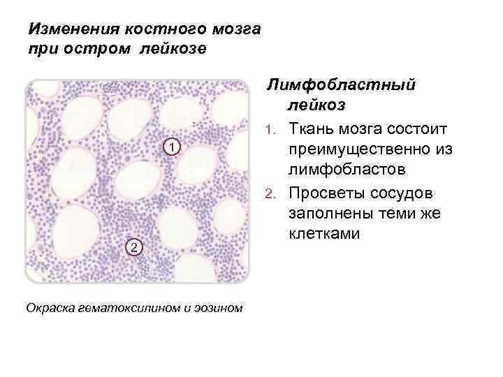 Изменения костного мозга при остром лейкозе 1 2 Окраска гематоксилином и эозином Лимфобластный лейкоз