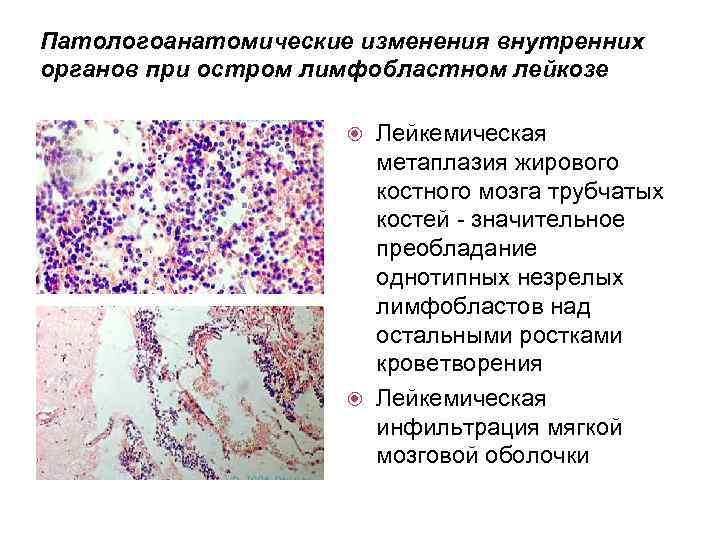 Патологоанатомические изменения внутренних органов при остром лимфобластном лейкозе Лейкемическая метаплазия жирового костного мозга трубчатых