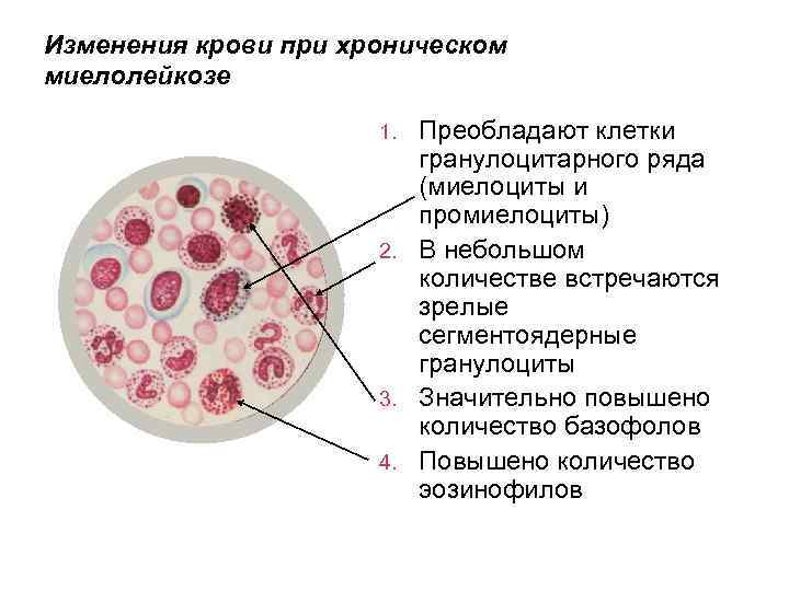 Изменения крови при хроническом миелолейкозе Преобладают клетки гранулоцитарного ряда (миелоциты и промиелоциты) 2. В