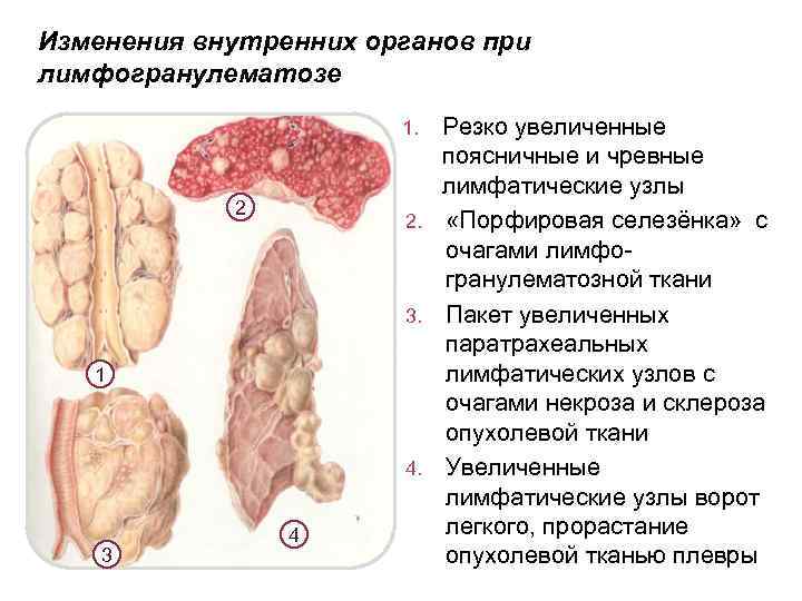 Изменения внутренних органов при лимфогранулематозе Резко увеличенные поясничные и чревные лимфатические узлы 2. «Порфировая