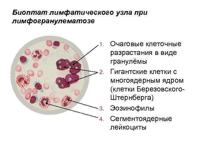 Биопсия при меланоме. Лимфогранулематоз лимфатического узла. Лимфатический узел при лимфогранулематозе. Биопсия лимфатического узла при лимфогранулематозе.