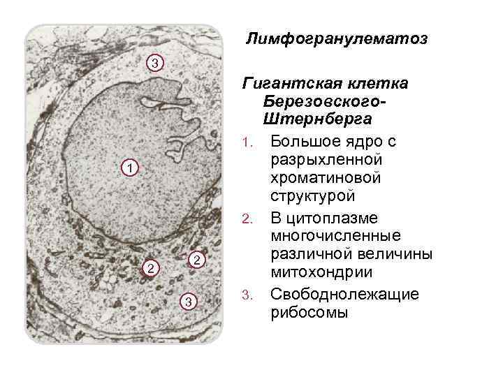 Лимфогранулематоз 3 1 2 2 3 Гигантская клетка Березовского. Штернберга 1. Большое ядро с