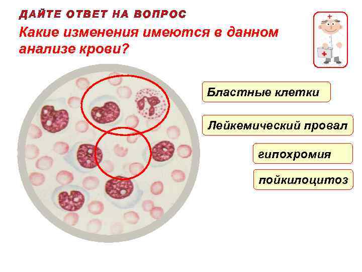 ДАЙТЕ ОТВЕТ НА ВОПРОС Какие изменения имеются в данном анализе крови? Бластные клетки Лейкемический